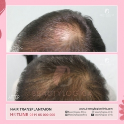 HAIR-TRANSPLANTAION-03