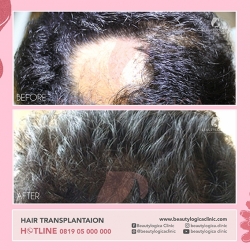 HAIR-TRANSPLANTAION-04