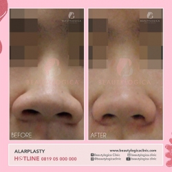 1_ALARPLASTY-01