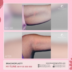 1_BRACHIOPLASTY-01
