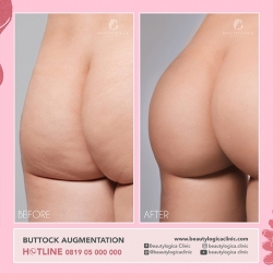 1_BUTTOCK-AUGMENTATION-01
