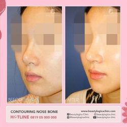 1_CONTOURING-NOSE-BONE-01