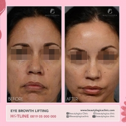 1_EYE-BROWTH-LIFTING-01
