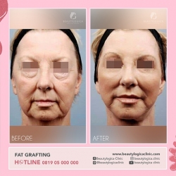 1_FAT-GRAFTING-01