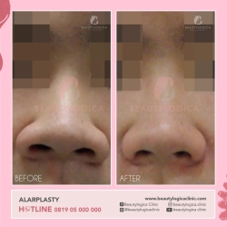 ALARPLASTY-01