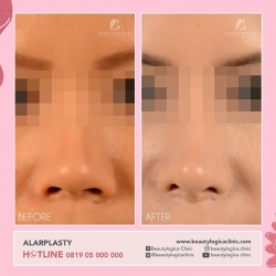 ALARPLASTY-02