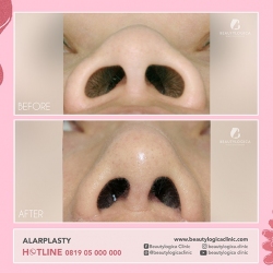 ALARPLASTY-04
