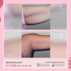 BRACHIOPLASTY-01