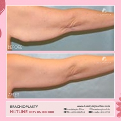 BRACHIOPLASTY-02