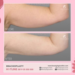 BRACHIOPLASTY-03