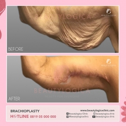BRACHIOPLASTY-04