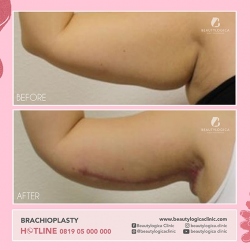 BRACHIOPLASTY-05
