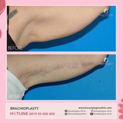 BRACHIOPLASTY-06
