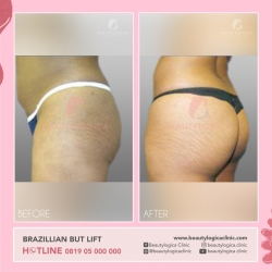 BRAZILLIAN-BUT-LIFT-01