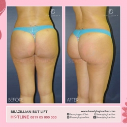 BRAZILLIAN-BUT-LIFT-02