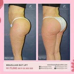 BRAZILLIAN-BUT-LIFT-03