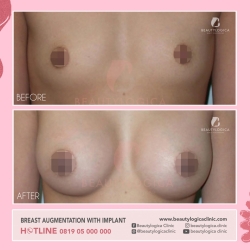 BREAST-AUGMENTATION-01