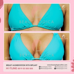 BREAST-AUGMENTATION-03