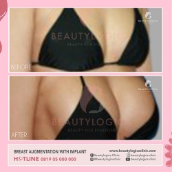 BREAST-AUGMENTATION-04