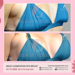 BREAST-AUGMENTATION-05