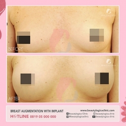 BREAST-AUGMENTATION-06