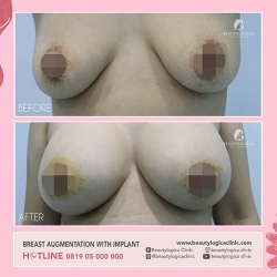 BREAST-AUGMENTATION-07