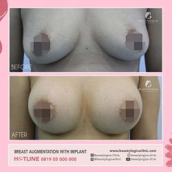 BREAST-AUGMENTATION-08