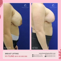 BREAST-LIFTING-01