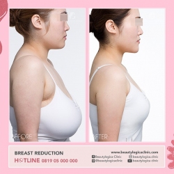 BREAST-REDUCTION-01