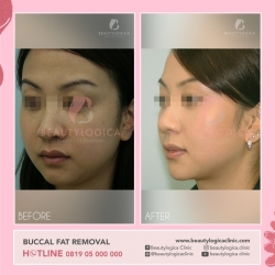 BUCCAL-FAT-01