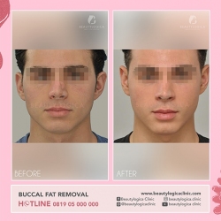 BUCCAL-FAT-07