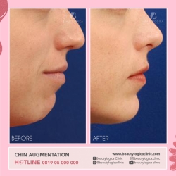 CHIN-AUGMENTATION-01