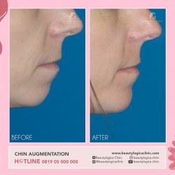 CHIN-AUGMENTATION-02