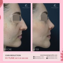 CHIN-REDUCTION-01