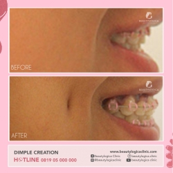 DIMPLE-CREATION-01