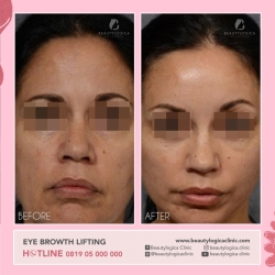 EYE-BROWTH-LIFTING-01