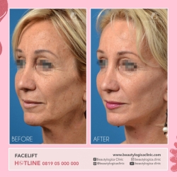 FACELIFT-1