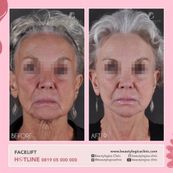 FACELIFT-2