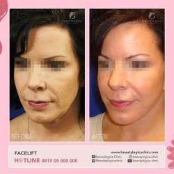 FACELIFT-3