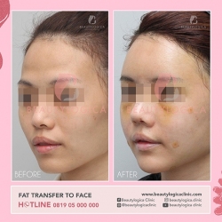 FAT-TRANSFER-TO-FACE-01
