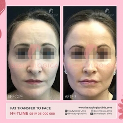 FAT-TRANSFER-TO-FACE-02