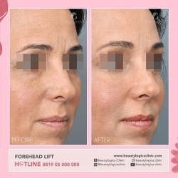 FOREHEAD-LIFT-01