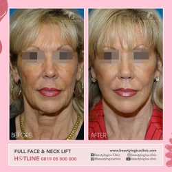 FULL-FACE-NECK-LIFT-01