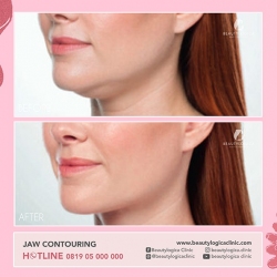 JAW-CONTOURING-01