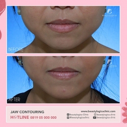 JAW-CONTOURING-02