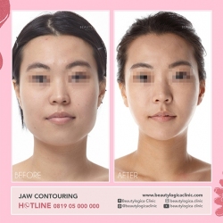 JAW-CONTOURING-03