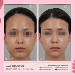 JAW-REDUCTION-01