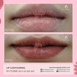 LIP-CONTOURING-01