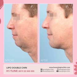 LIPO-DOUBLE-CHIN-01