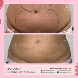 LIPOSUCTION-01